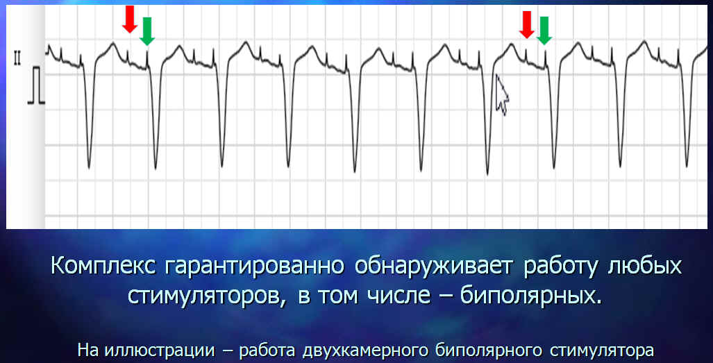 Обнаружение импульса биполярного ИВР, ЭКС, кардиостимулятора