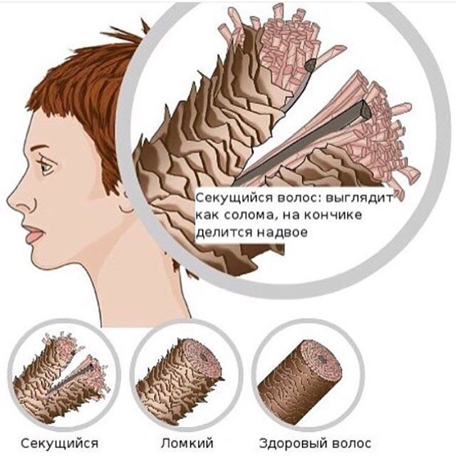 Ломкость волос. Причины явления и способы решения проблемы