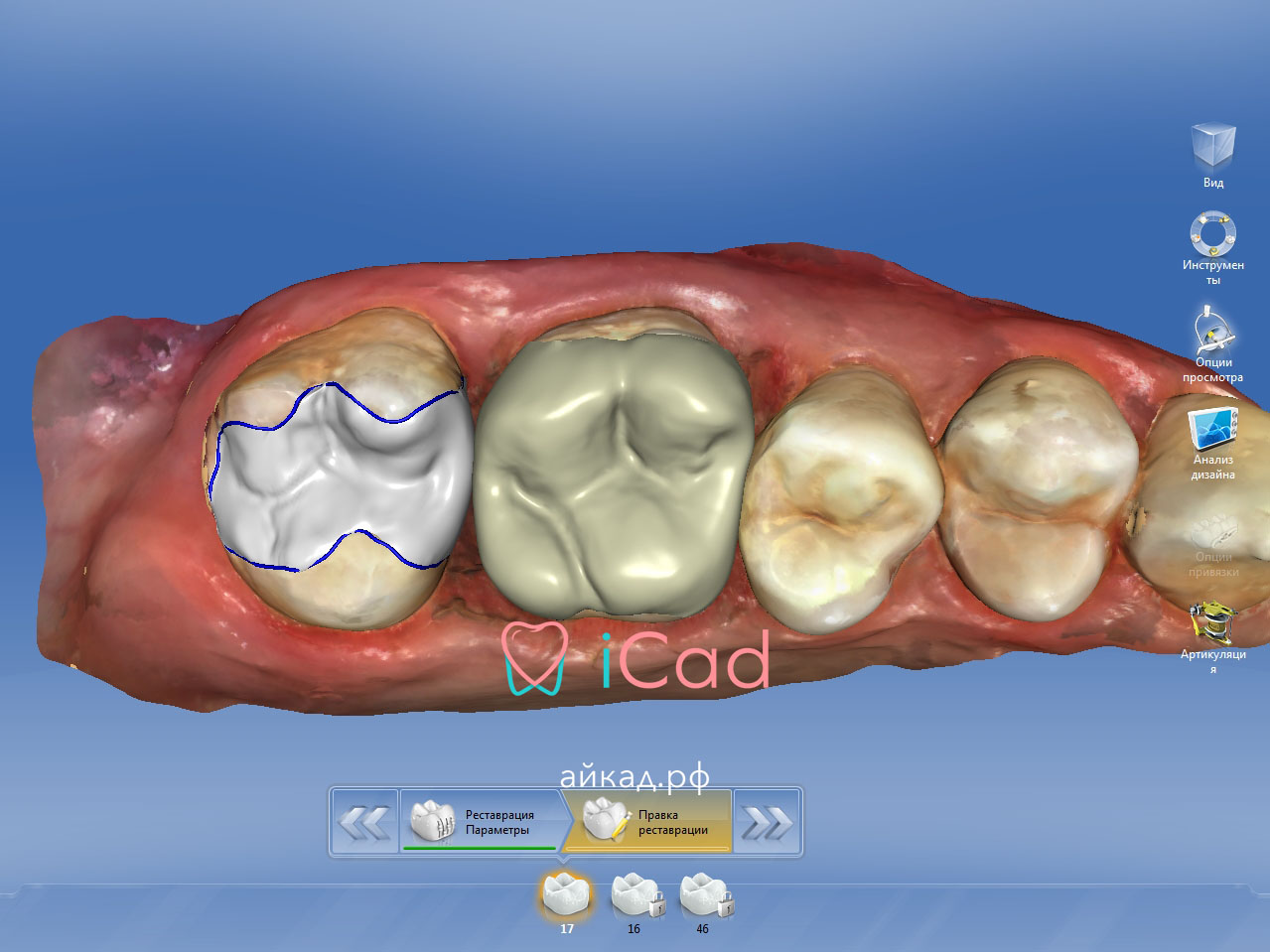 cad cam системы в стоматологии, современные cad cam, кад кам системы в стоматологии, обучение cam системам, айкад.рф, icad.store, продажа стоматологического оборудования, москва