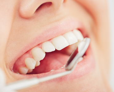 Лечение зубов быстро и эффективно