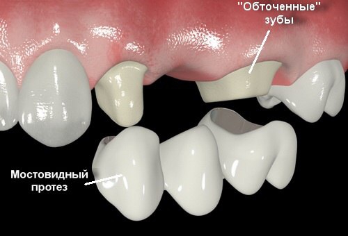 Что такое зубной мост фото