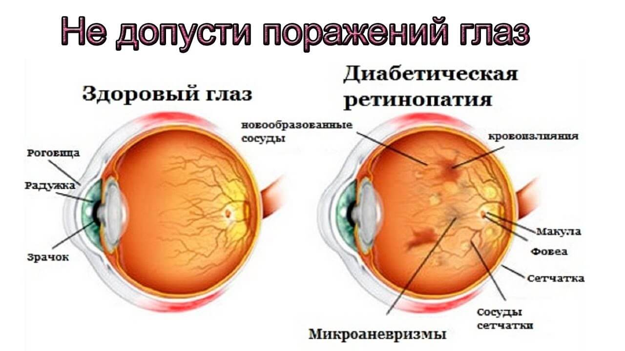 diabeticheskaya-retinopatiya.jpg